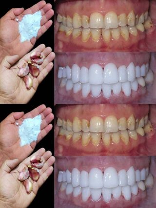 Jak wybielić zęby w 2 minuty?