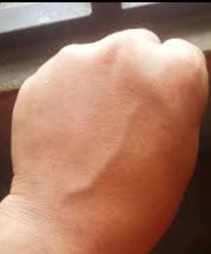 Stany zdrowia, które mogą powodować widoczne żyły