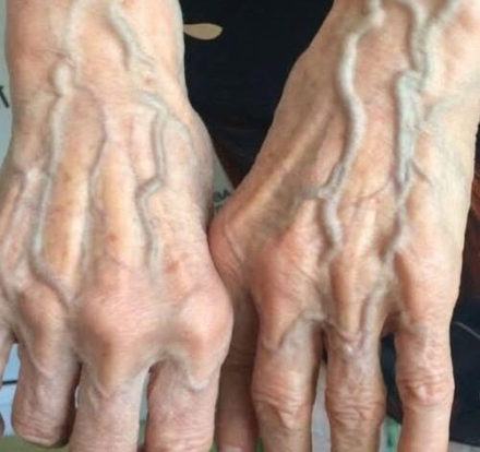 Kiedy należy martwić się żyłami, które pojawiają się niespodziewanie!?