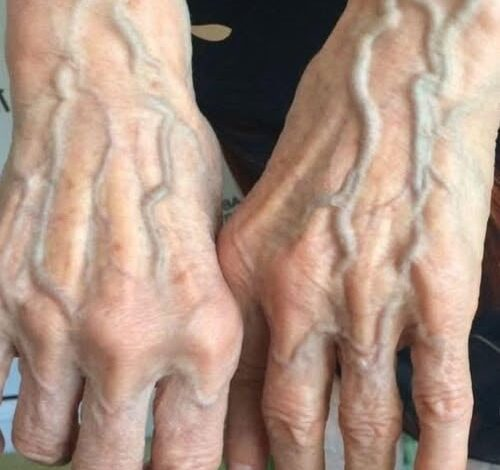 Kiedy należy martwić się żyłami, które pojawiają się niespodziewanie!?