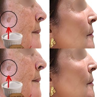 NIESAMOWITE! Soda oczyszczona usuwa plamy starzeniowe jak gumka do gumy (czy wiedziałeś?)